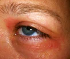 Kosmetikallergie Symptome Augen