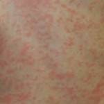 Soja Allergie Hautausschlag Körper