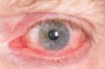 Hausstauballergie Symptom Auge
