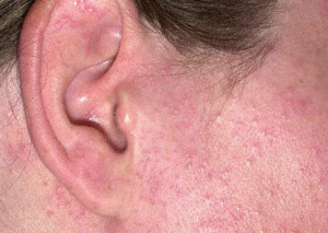 Nickelallergie: Symptome, Bilder, was hilft bei einer Nickel Allergie