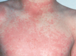 Hausstauballergie Symptom juckender Hautausschlag