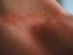 Ei-Allergie Hautausschlag Hals