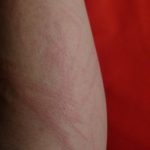 Papier Allergie Hautausschlag Arm