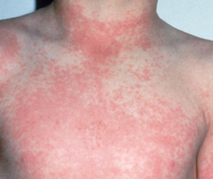 Sonnenallergie Hautausschlag an Hals und Brust