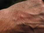 Goldallergie Symptome Hand