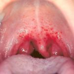 Soja Allergie Ausschlag im Mund