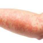 Ibuprofen-Allergie Symptome Hautausschlag am Arm