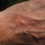 Papier Allergie Hautausschlag Hand