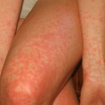 Latex Frucht Syndrom Allergie Hautausschlag