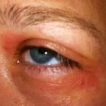 Eibe Allergie Symptome gerötete Augen