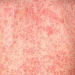 Krätze Allergie Symptome Haut