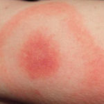 Zeckenbiss Allergie Hautausschlag geschwollen